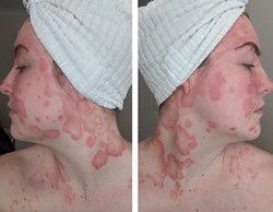 Yasmin Facial Psoriasis